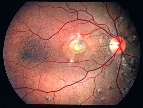 Angioid Streaks Pxe Case 2 Retina Image Bank