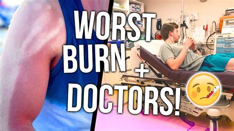 THE WORST SUNBURN EVER EMERGENCY DOCTORS VISIT YouTube