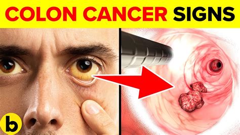 Cancer spreads beyond the colon wall without lymph node. 11 Early Signs Of Colon Cancer You NEED TO KNOW - YouTube