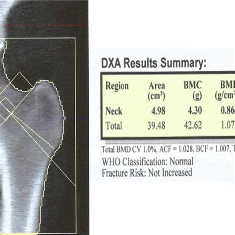 Normal Dexa Scan Of A Patient Download Scientific Diagram