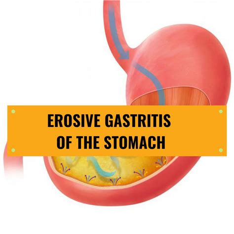 Erosive Gastric Gastritis Causes Symptoms And Treatment