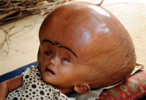 Indian Giant Head Baby Roona Begum In Surgery To Save Life Ibtimes Uk