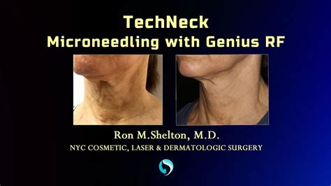 How To Get Rid Of Tech Neck — Creases In Your Neck Neck Lines Caused