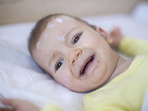 Eczema In Babies Babycenter