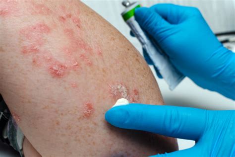 Psoriasis Medical Treatment With Topical Creams And Medicines