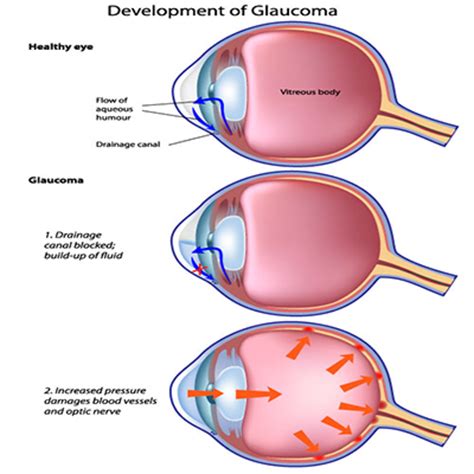 In people with glaucoma, a buildup of fluid causes pressure in the eye to increase. Glaucoma Treatments - Ophthalmologist | Queens| New York ...