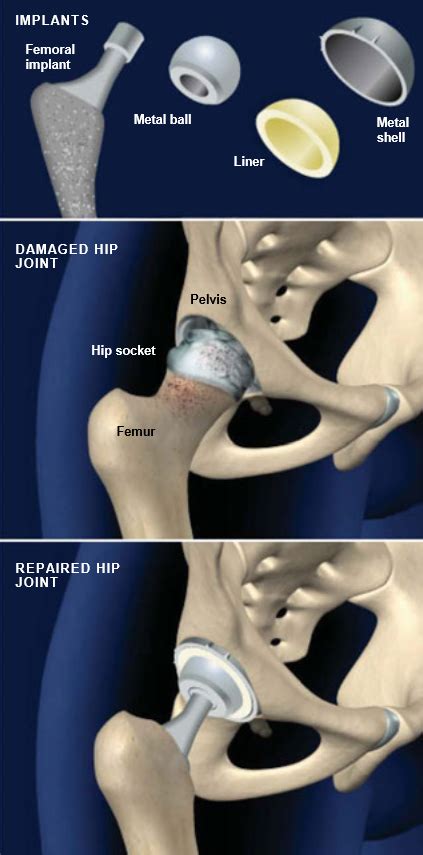 Total Hip Replacement Anterior Approach Central Coast Orthopedic