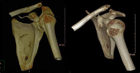 Combined Acromioclavicular Joint Dislocation And Coracoid Avulsion In