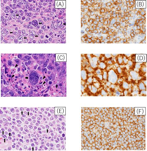 Histology Of Polyploid Diffuse Large B Cell Lymphoma Dlbcl A He