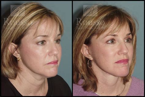 Patient 2127511 Mini Lift Before And After Rousso Facial Plastic Surgery