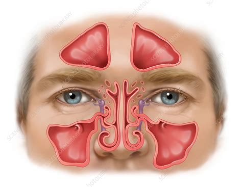 Sinus Infection Swollen Face