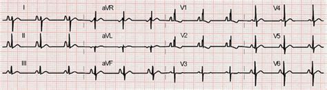 Atrial Septals Defect Asd On The Electrocardiogram