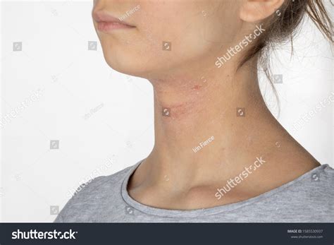 Allergic Itchy Skin On Girl Neck Stock Photo 1585530937 Shutterstock