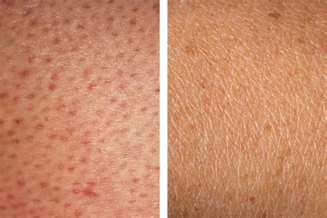 How To Get Rid Of Strawberry Legs 5 Treatments That Work Strawberry