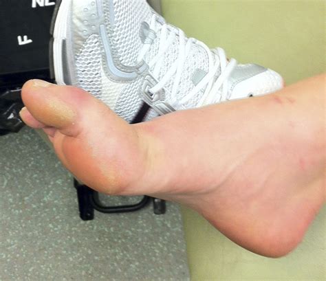 It happens most often in football players, but it can happen in other sports and. Turf toe injury | Emergency Medicine Journal