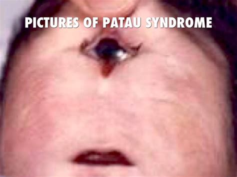 Patau Syndrome By Shawn Mcdonald