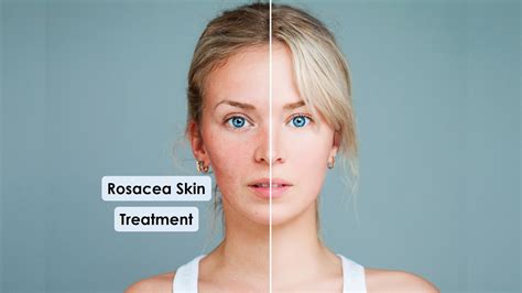 Rosacea Skin Care Tips Causes And Natural Skin Care Products