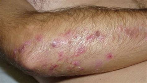 Itchy Elbows With Red Bumps Rash Welts Treatment Remedies Treat