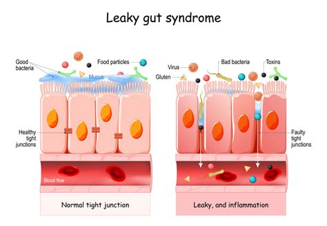 Leaky Gut Syndrome Treatment Proactive Wellness Centers