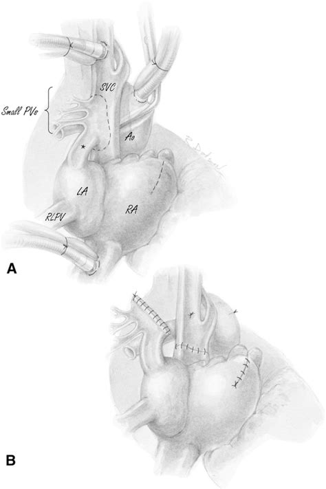 Figure 1 From Partial Anomalous Pulmonary Venous Connection With