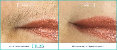 In general, lhr treatment on small areas is cheaper than on bigger areas, like legs. Upper Lip Laser Hair Removal: How It Works, Benefits And ...