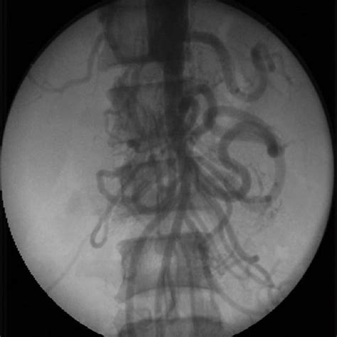 Percutaneous Transluminal Renal Angioplasty With Stent To Left Renal