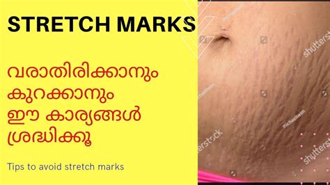 How To Avoid Stretch Marks How To Remove Stretch Markshome Remedies