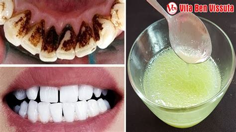 Tra i rimedi naturali più noti per sbiancare i denti a casa c'è il bicarbonato di sodio, che se mixato a un po' di sale da cucina può dar vita ad un dentifricio sbiancante. 5 Modi per Sbiancare i Denti, Sbarazzarsi di alito cattivo ...