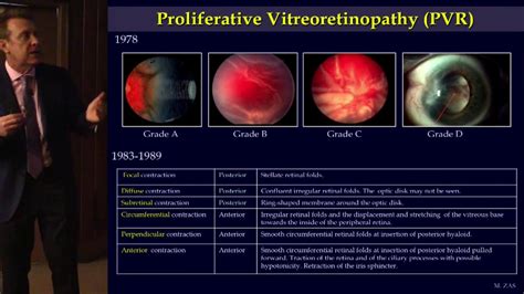Retinal Stem Cells And Proliferative Vitreoretinopathy Prof Dr
