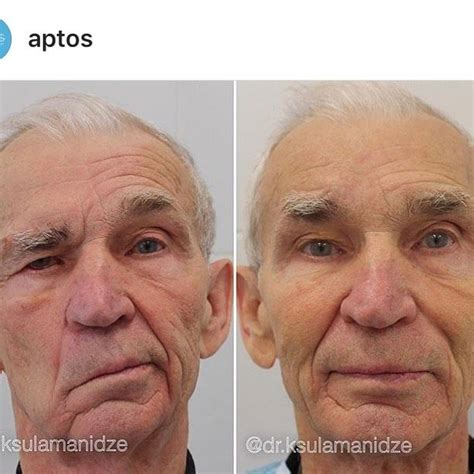 Dr Buddy Paul Beaini On Instagram “facial Asymmetry Repair With Aptos