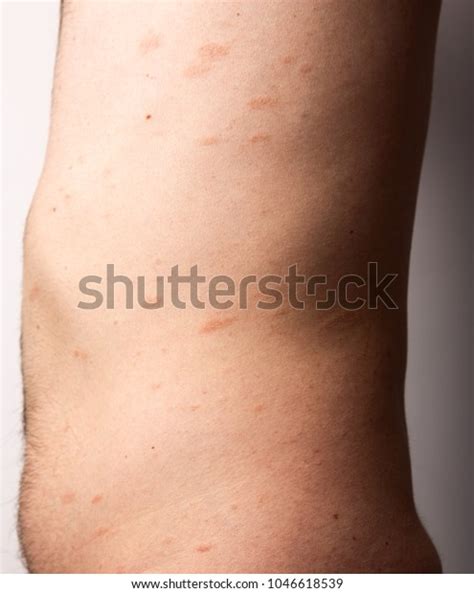 Pityriasis Rosea Herpes Red Spots On Stock Photo 1046618539 Shutterstock