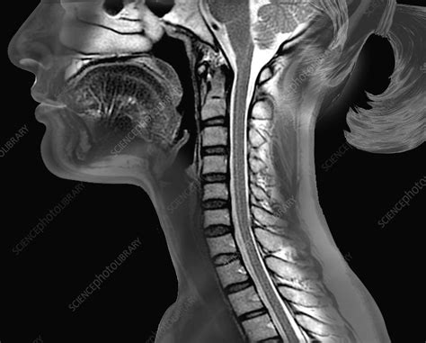 Cervical Spine And Brainstem Mri Scan Stock Image C0371654