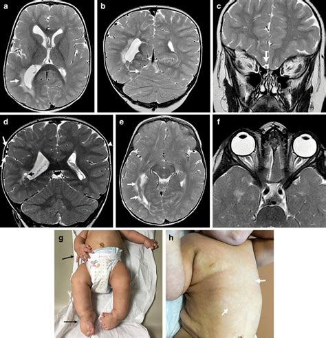 Megalencephaly Capillary Malformation Mcap Syndrome In A