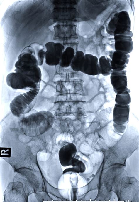 Computed Tomography Of The Abdomen Pelvis Radiology Associates Of