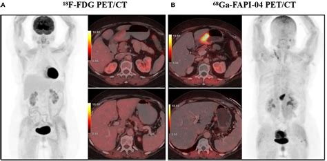 Frontiers Fapi Petct In The Diagnosis Of Abdominal And Pelvic Tumors