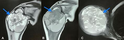 Cureus A 5 Year Old Female With An Aneurysmal Bone Cyst Of The