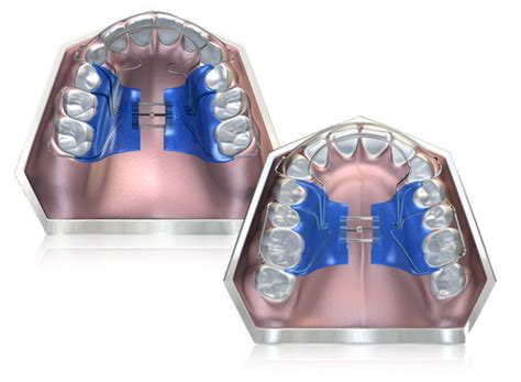What Is Biobloc Orthotropics — Lemchen Salzer Orthodontics Best