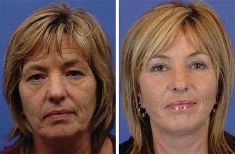 This stylish cut adds body to your cut, a must for you if your hair is growing limp and dry as you age. Face improvements without surgery. Sagging jowls and turkey neck can be toned and firmed with ...