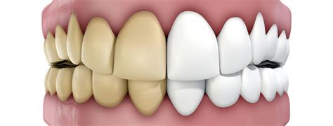 How To Conquer The 9 Main Reasons For Tooth Discoloration Op Dental Care
