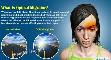 Ocular Migraines Explained Ocular Migraine Migraine Migraine Relief