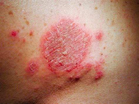 Dermatitis Numular Trastornos Dermatológicos Manual Msd Versión