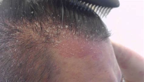 How To Treat Psoriasis And Dry Scalp With Shampoo Paul M
