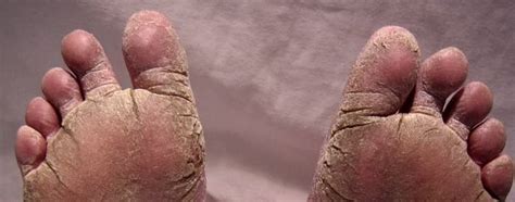 Psoriasis On The Feet Flaym