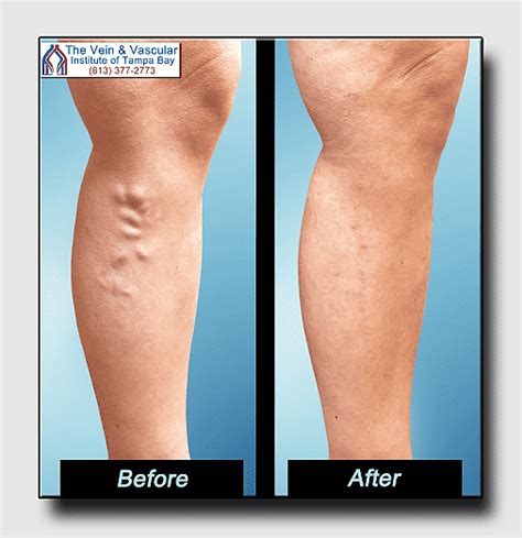 Endovenous Laser Treatment Sclerotherapy Radiofrequency Ablation