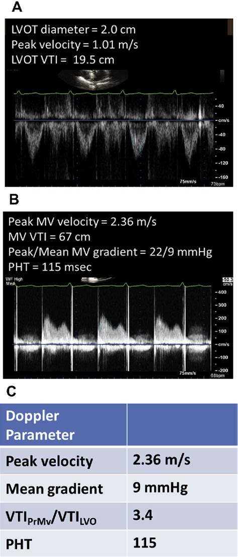 Figure 10 From Mitral Prosthetic Valve Assessment By Echocardiographic