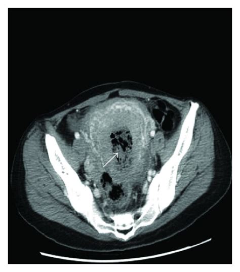 √ uterus endometriosis ct scan tumors of the uterine corpus clinical gate the best way to