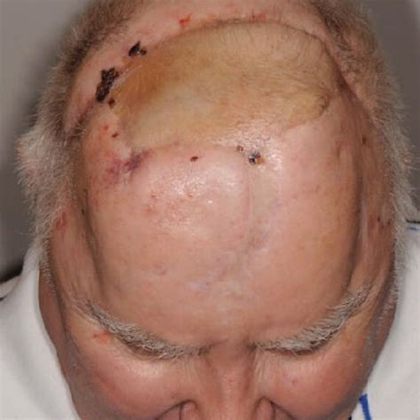 Intraoperative View After Resection Of The Scalp And The Infiltrated