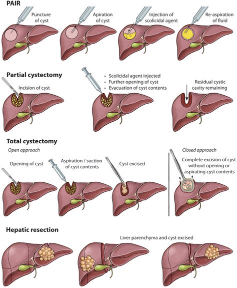 Management Approaches For Liver Cystic Echinococcosis Vary From