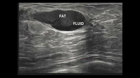 Differentiating Breast Abscess And Galactocele On Ultrasound With
