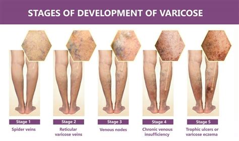 Varicose Veins Vs Spider Veins Florida Lakes Vein Center Vein Center